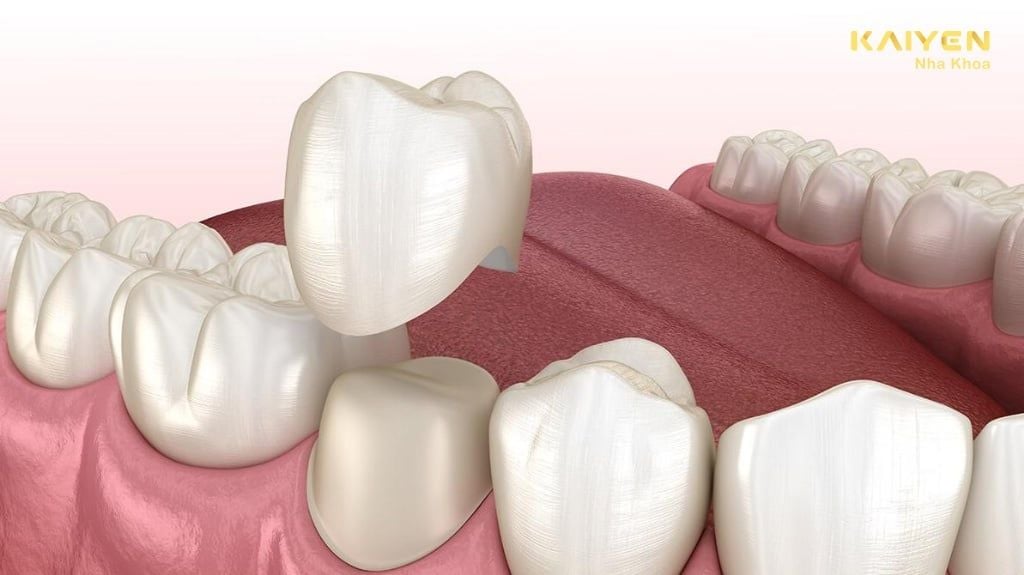 Bọc Răng Sứ Cho Răng Khểnh - Quy Trình Diễn Ra Thế Nào?