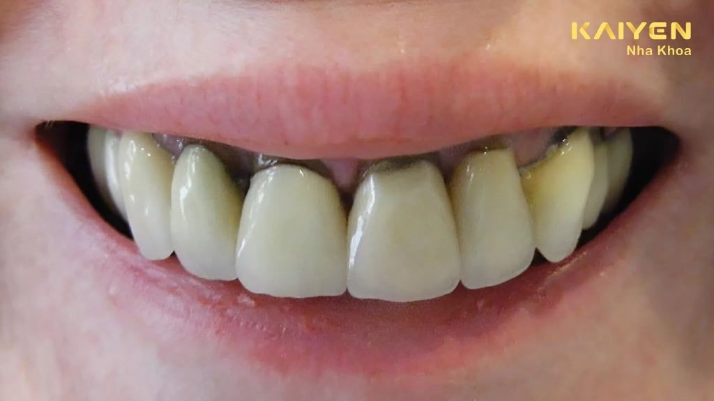 Chân Răng Bị Đen: Nguyên Nhân Và Cách Khắc Phục