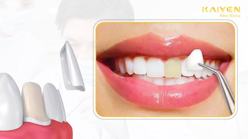 Dán răng sứ có tốt không? Có bền không? Có ưu nhược điểm gì?