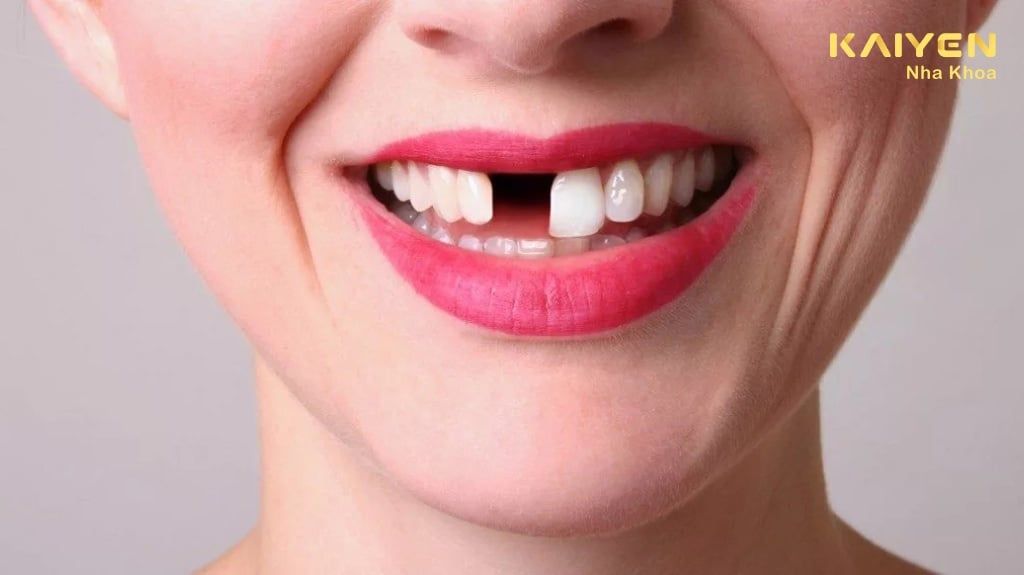 Trường Hợp Nào Nên Nhổ Răng Cửa