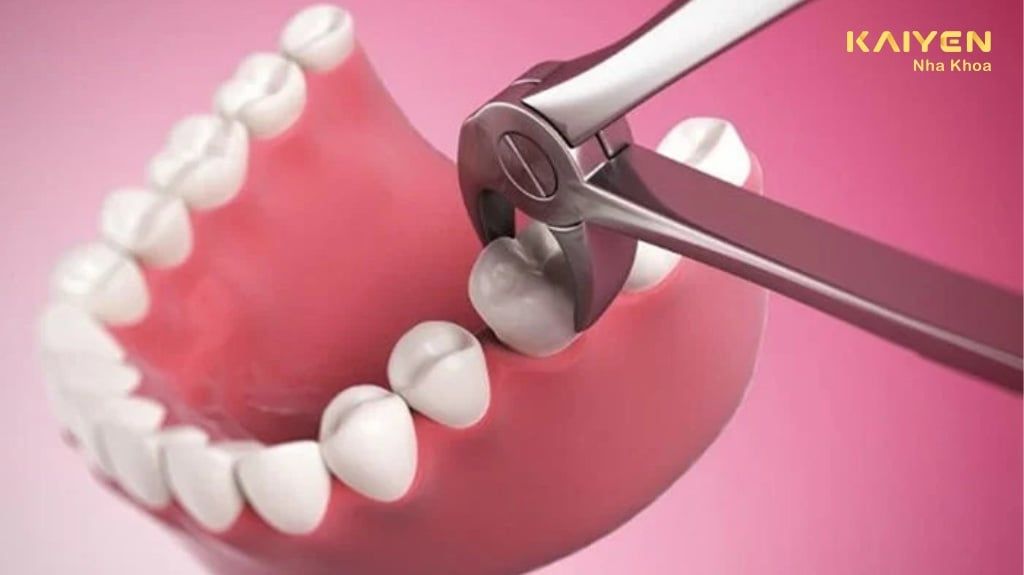 Nhổ Răng Hàm Dưới Có Ảnh Hưởng Gì Không?