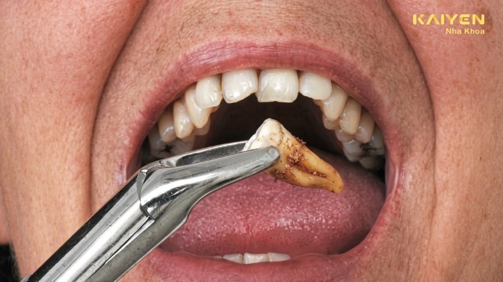 Nhổ Răng Khôn Hàm Trên Có Nguy Hiểm Không?