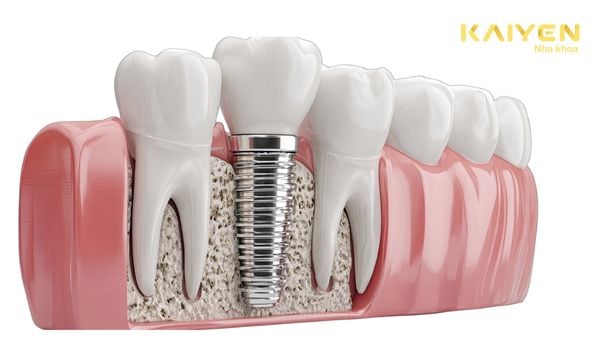 Quy Trình Cấy Ghép Implant Không Đau
