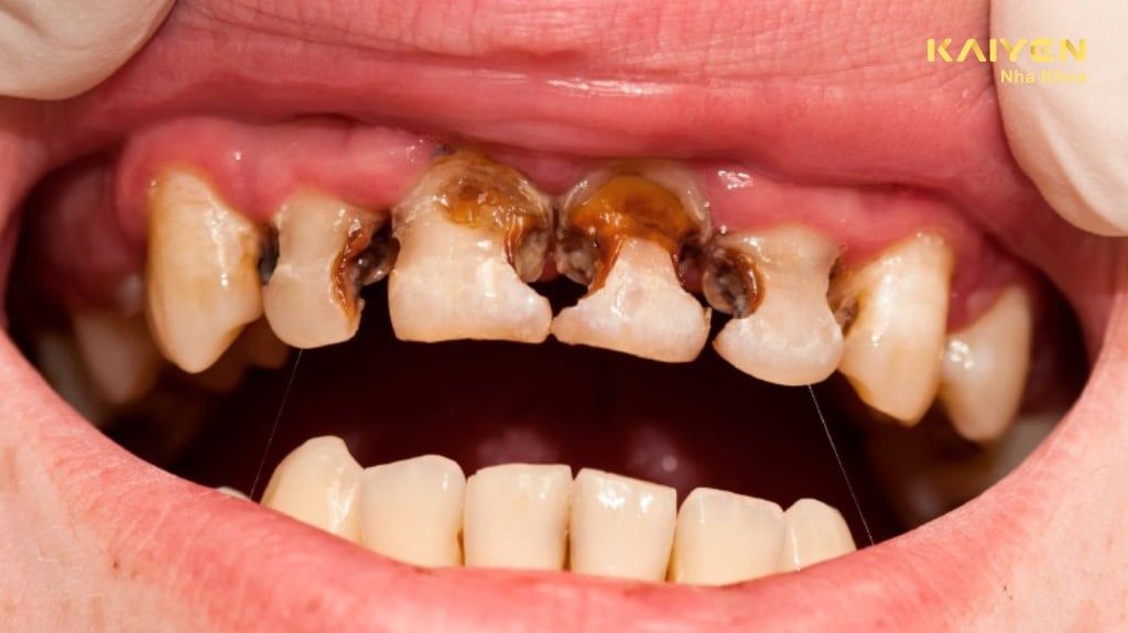 Nhổ Răng Sâu Có Nên Hay Không? Khi nào nên nhổ răng sâu