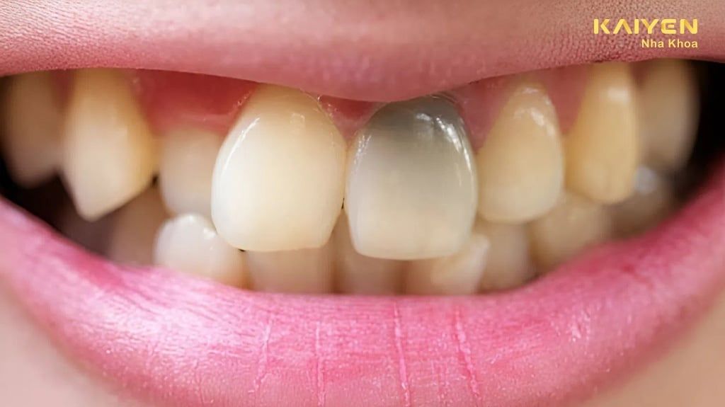 Răng Sau Khi Chữa Tủy Tồn Tại Được Bao Lâu?