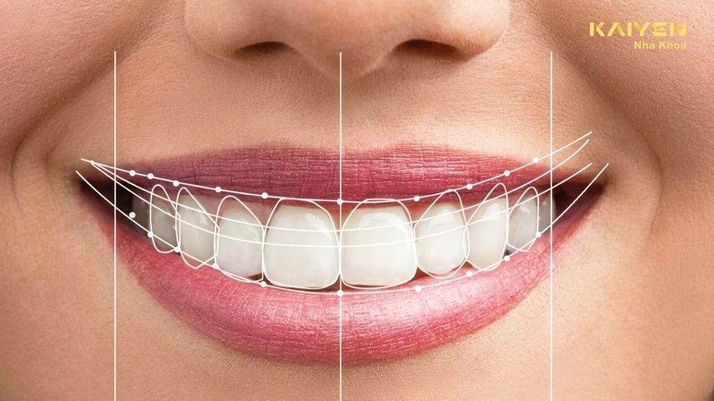 Thiết Kế Nụ Cười – Bước Đệm Quan Trọng Để Kiến Tạo Nụ Cười Đẹp