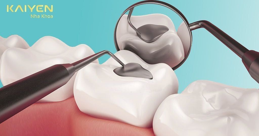 Trám Răng Sâu Lỗ To, Bị Vỡ Có Được Không