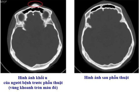 Bệnh viện Việt Nam - Thụy Điển Uông Bí phẫu thuật thành công ca u xương sọ hiếm gặp