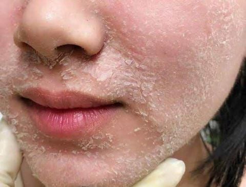 Nhưng lưu ý trong phục hồi làn da mỏng yếu, hư tổn sau peel và laser