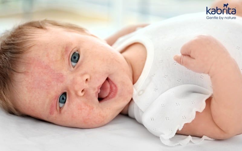 Trẻ sơ sinh bị rôm sảy: Hướng dẫn chăm sóc, phòng ngừa và điều trị tại nhà