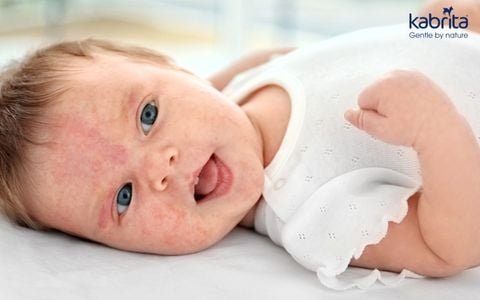 Trẻ sơ sinh bị rôm sảy: Hướng dẫn chăm sóc, phòng ngừa và điều trị tại nhà