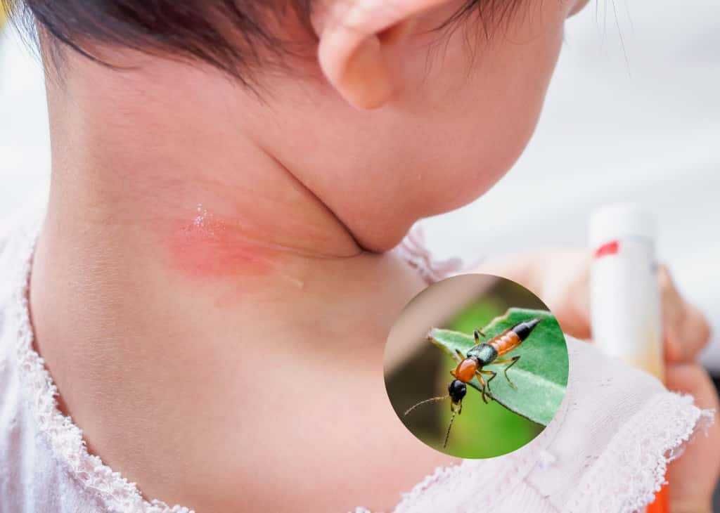 Trẻ bị kiến ba khoang đốt phải làm sao? Dấu hiệu và cách xử lý an toàn