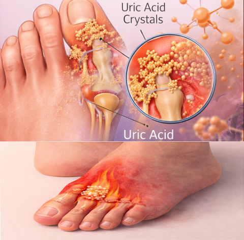 XÔNG HƠI THẢO MỘC DAO ĐỎ – HỖ TRỢ ĐÀO THẢI AXIT URIC, GIẢM ĐAU NHỨC CHO NGƯỜI BỊ GOUT