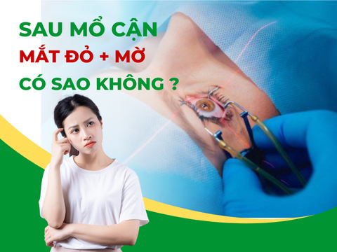 Sau mổ cận mắt đỏ, mờ có sao không? – Bác sĩ Bệnh viện Mắt Hà Nội – Hà Nam giải đáp