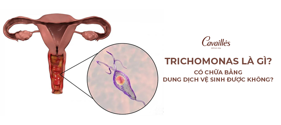 Trichomonas là gì? Có chữa bằng dung dịch vệ sinh được không?
