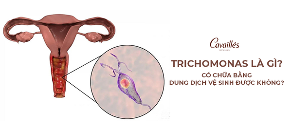 Trichomonas là gì? Có chữa bằng dung dịch vệ sinh được không?