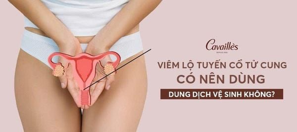 Viêm lộ tuyến cổ tử cung có nên dùng dung dịch vệ sinh không?