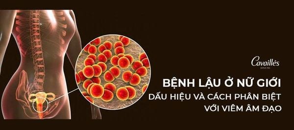 Bệnh lậu ở nữ giới: Dấu hiệu và cách phân biệt với viêm âm đạo