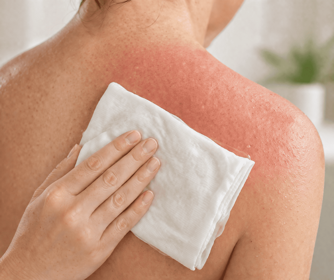 Cách chữa cháy nắng đơn giản tại nhà