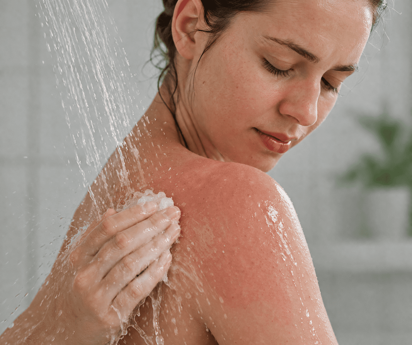 Cách chữa cháy nắng đơn giản tại nhà