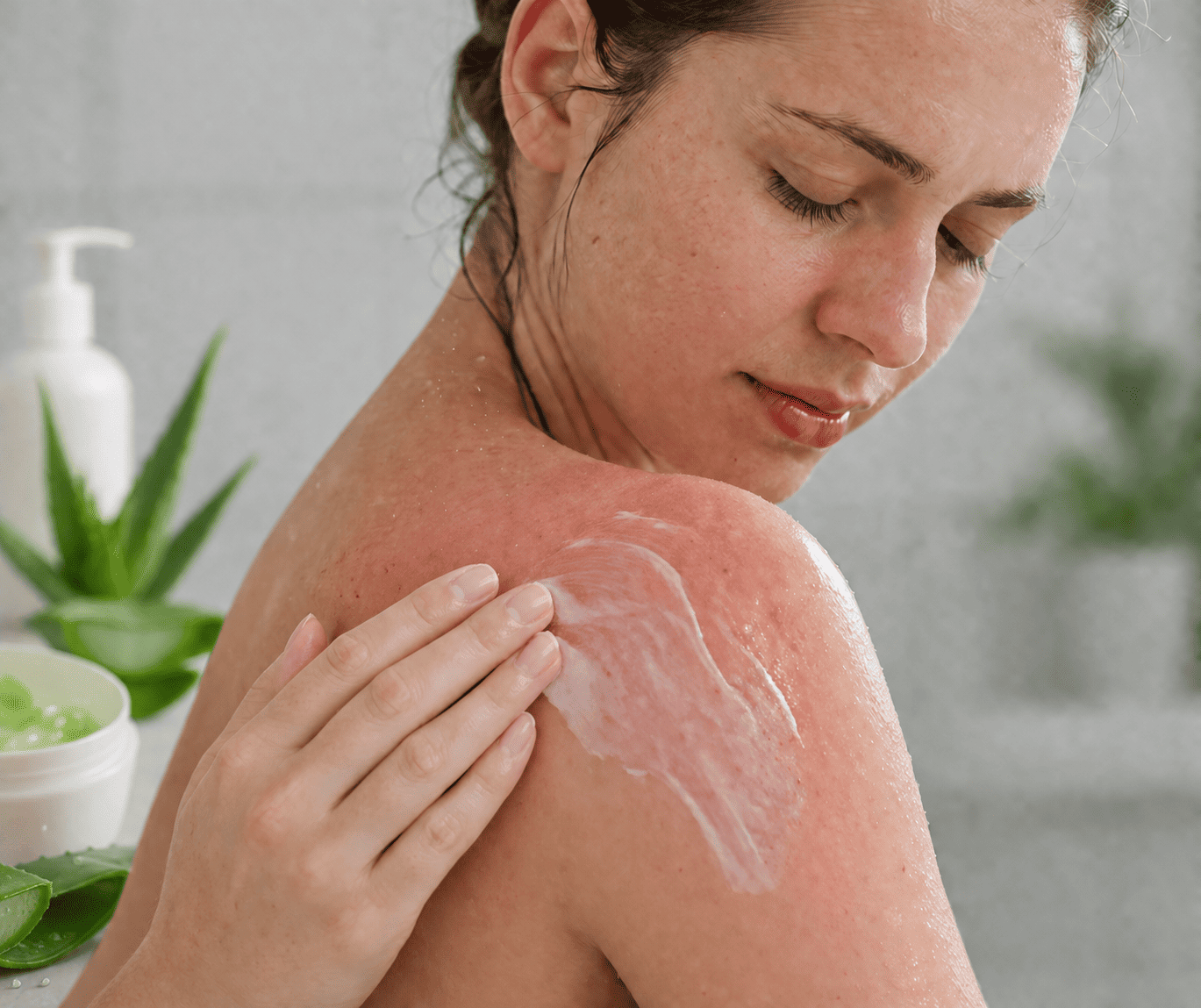 Cách chữa cháy nắng đơn giản tại nhà