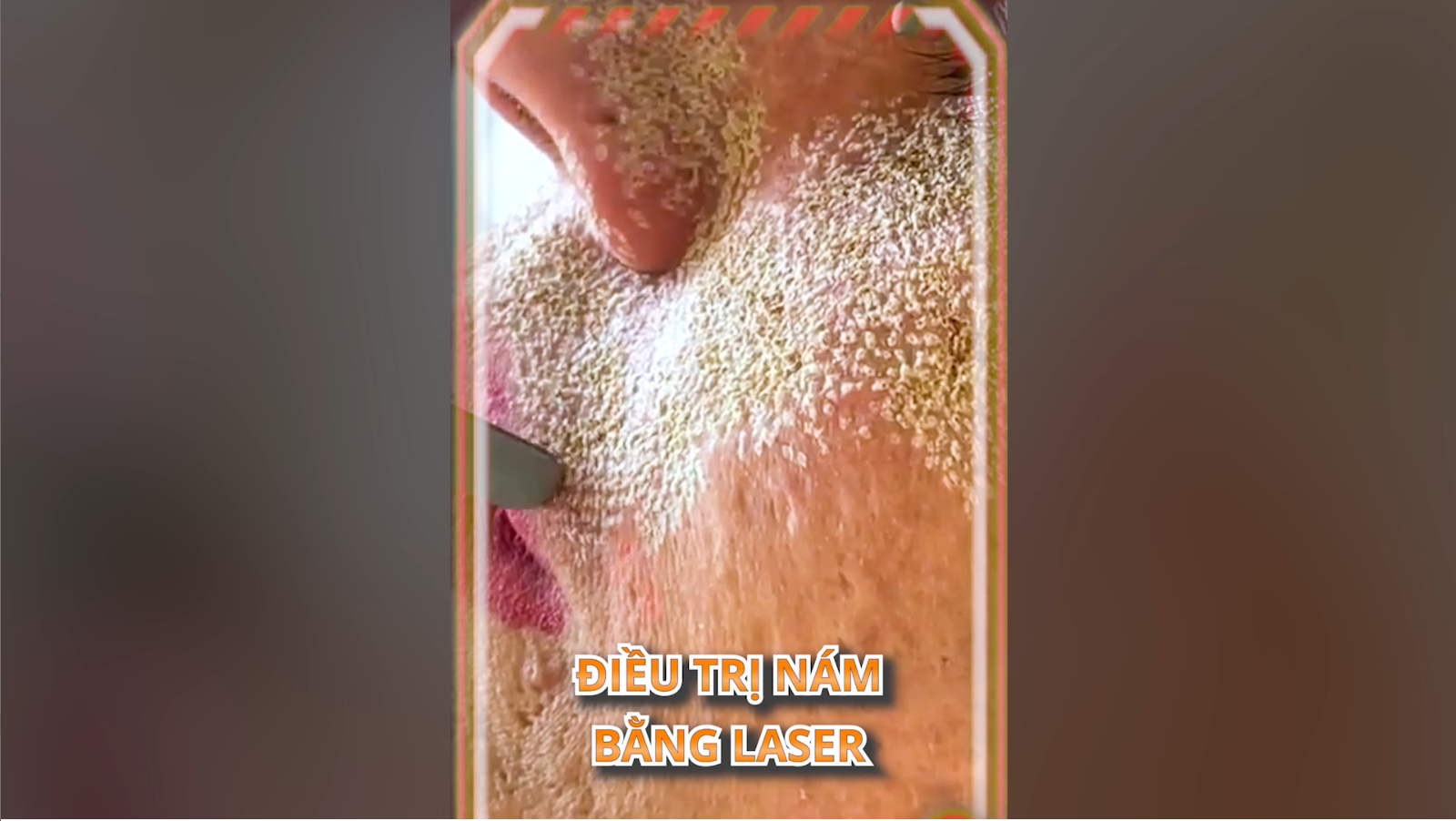 ĐIỀU TRỊ NÁM BẰNG LASER CÓ NGUY HIỂM