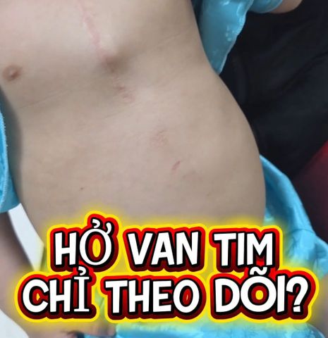 HỞ VAN TIM Ở TRẺ: CÓ TRƯỜNG HỢP CHỈ THEO DÕI, CÓ TRƯỜNG HỢP CẦN ĐIỀU TRỊ SỚM