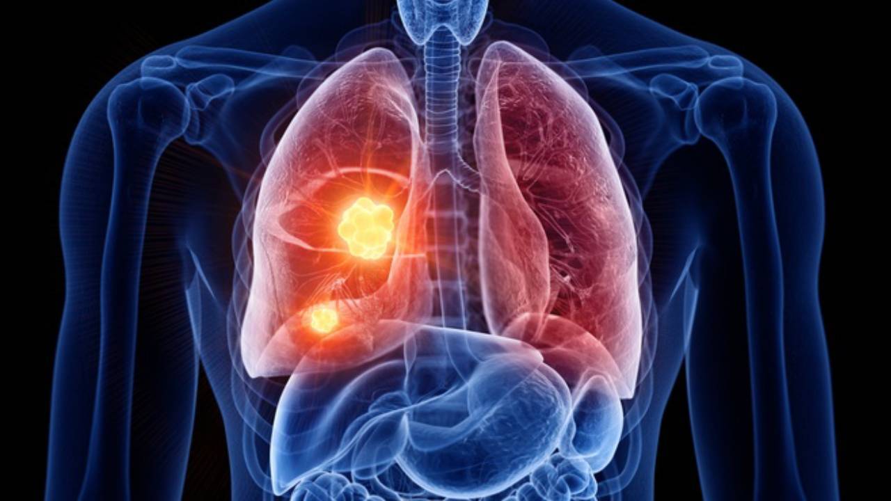 Tầm soát ung thư phổi và những điều cần lưu ý