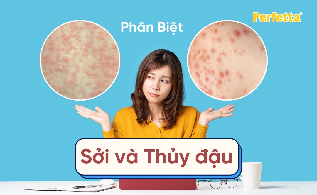 Phân biệt sởi và thủy đậu cụ thể và cách nhận biết