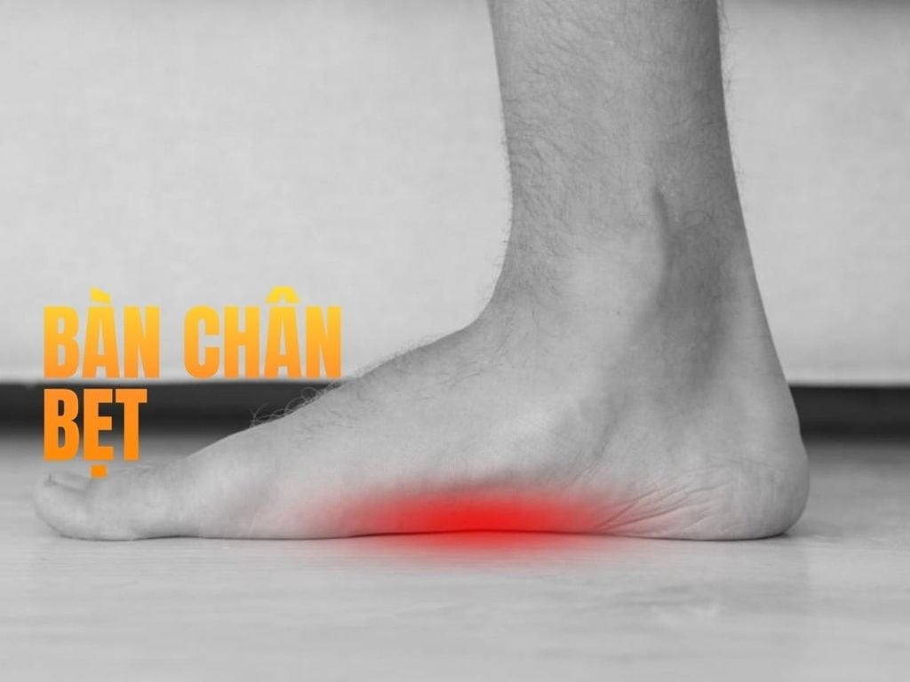 Bàn chân bẹt là gì?