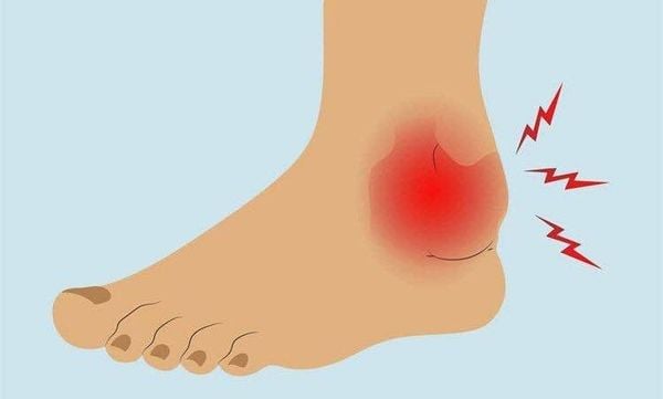 Câu hỏi thường gặp về đau cổ chân khi chạy bộ
