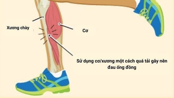 Đau ống đồng khi chạy bộ là tình trạng gì?