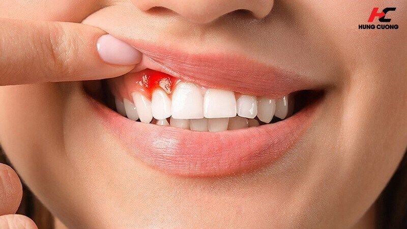 Các dấu hiệu thừa Omega