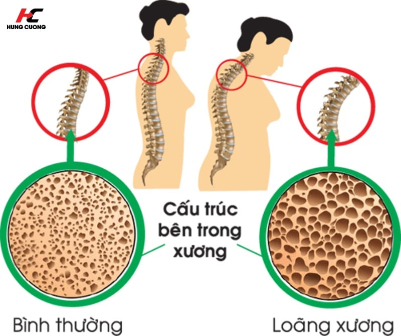 Loãng xương là do cấu trúc bên trong xương thưa và mỏng dần