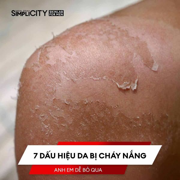 7 dấu hiệu da bị cháy nắng anh em dễ bỏ qua