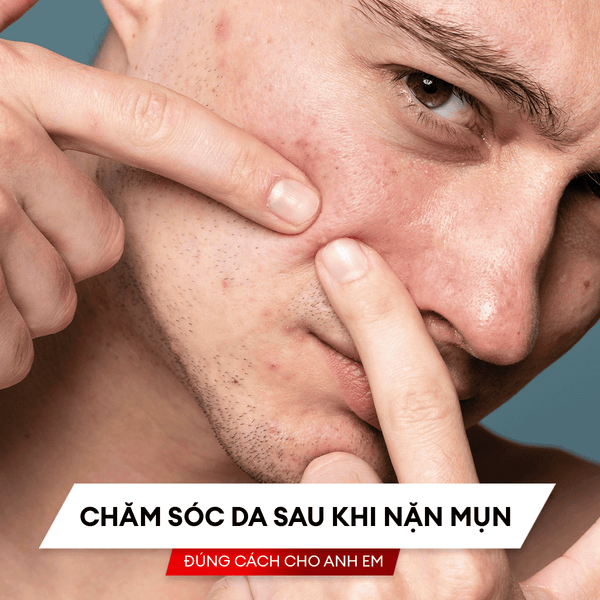 Chăm sóc da sau khi nặn mụn đúng cách cho anh em
