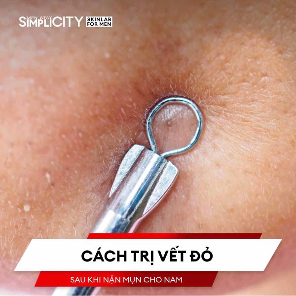 Cách trị vết đỏ sau khi nặn mụn cho nam