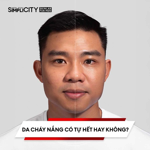 Da cháy nắng có tự hết hay không?