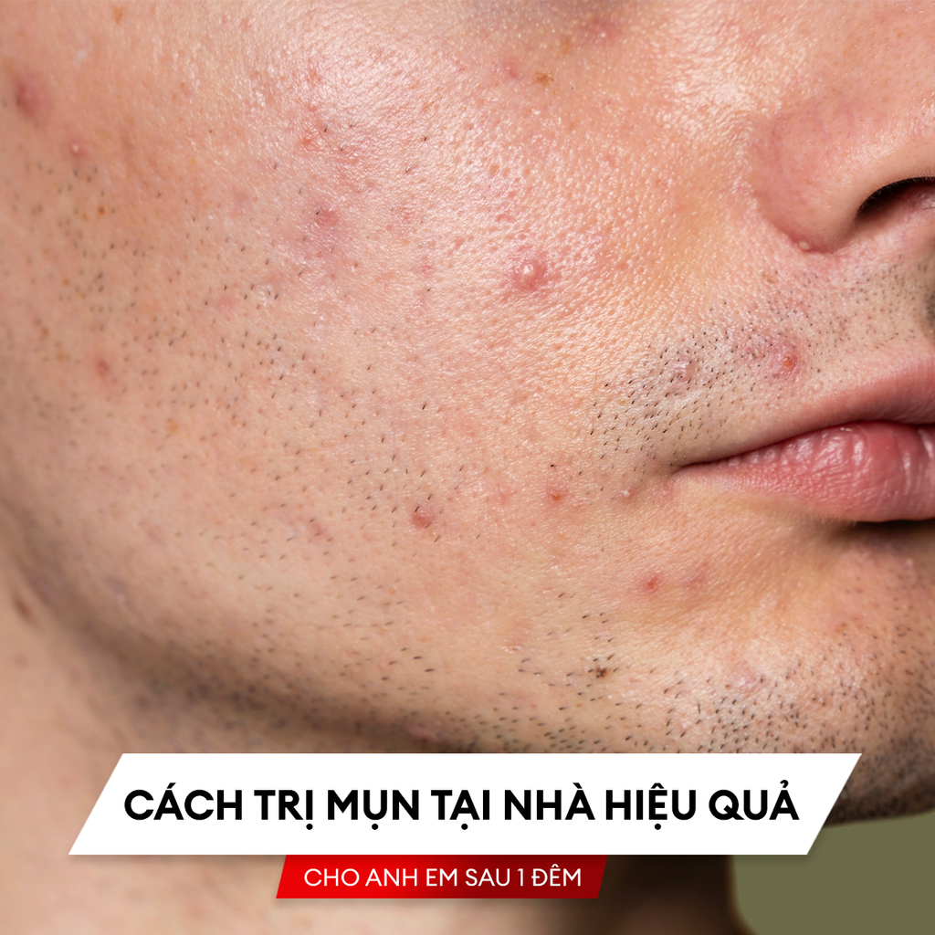 Cách trị mụn tại nhà hiệu quả sau 1 đêm cho anh em