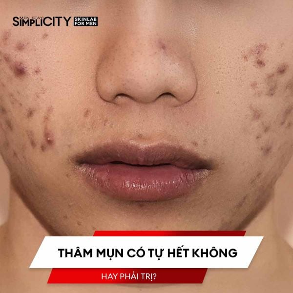 Thâm mụn có tự hết không hay phải trị?