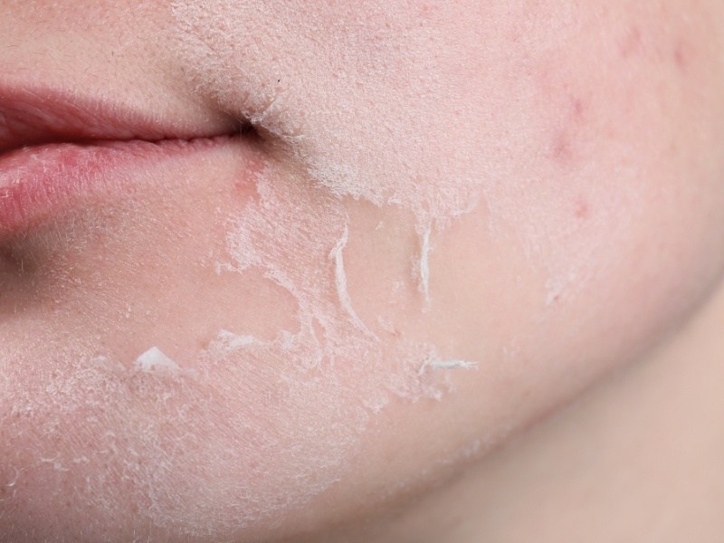 Cách chăm sóc da khô: Bí quyết dưỡng ẩm & liệu trình phục hồi da khô hiệu quả