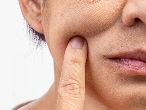 Nguyên nhân xuất hiện nếp nhăn & Cách giảm nếp nhăn hiệu quả