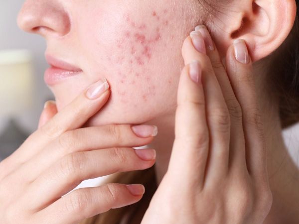 Cảm giác nóng trong người, nổi mụn có thể là dấu hiệu bị nóng gan và cần được chăm sóc đúng cách