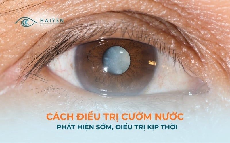 Điều trị cườm nước: Phương pháp và hướng chăm sóc an toàn