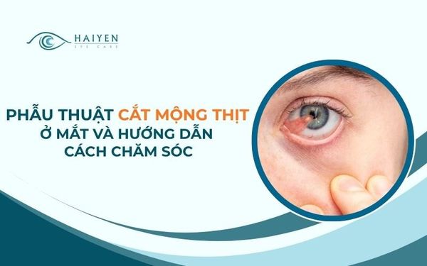 Phẫu Thuật Cắt Mộng Thịt Ở Mắt Và Hướng Dẫn Cách Chăm Sóc