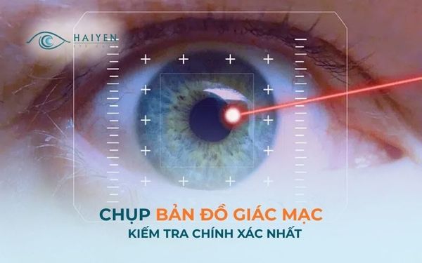 Chụp Bản Đồ Giác Mạc Là Gì? Lợi Ích Và Khi Nào Nên Thực Hiện?