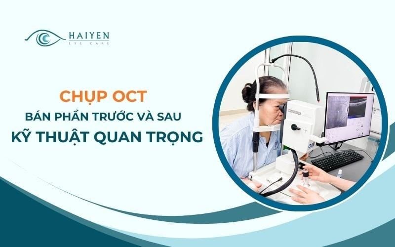 Chụp OCT Bán Phần Trước Và Sau, Đánh Giá Giác Mạc – Võng Mạc