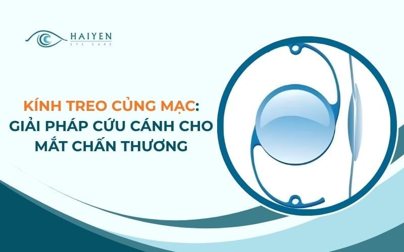 Kính Treo Củng Mạc: Giải Pháp Cứu Cánh Cho Mắt Chấn Thương