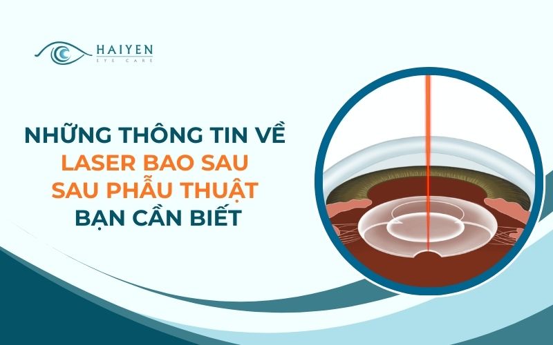 Những Thông Tin Về Laser Bao Sau Sau Phẫu Thuật Bạn Cần Biết