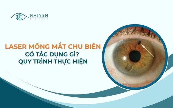 Laser Mống Mắt Chu Biên Có Tác Dụng Gì? Quy Trình Thực Hiện